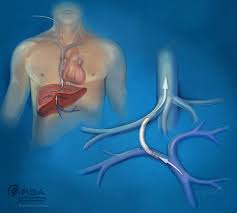 TIPS Procedure Treatment | An Effective Approach for Treating Portal Hypertension